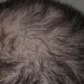 Theradome vs Irestore vs Hairmax - Hair Loss Solution
