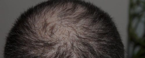 Theradome vs Irestore vs Hairmax - Hair Loss Solution
