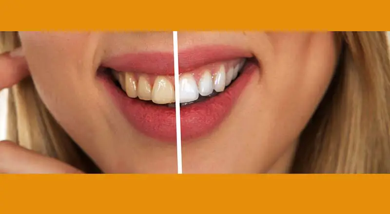 Tooth Discoloration Causes